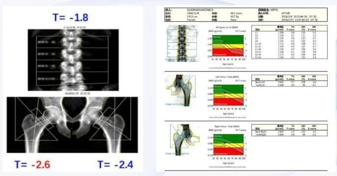  查骨密度用什么仪器准？——双能X射线骨密度仪是金标准